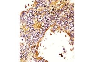 (ABIN387816 and ABIN2843905) staining EGFR in human lung adenocarcinoma sections by Immunohistochemistry (IHC-P - paraformaldehyde-fixed, paraffin-embedded sections). (EGFR anticorps)