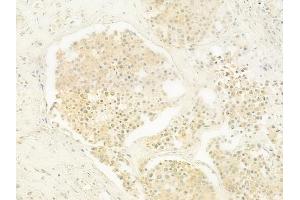 ABIN6262334 and ABIN6279483 at 1/100 staining human prostate carcinoma by IHC-P. (HNRPDL anticorps  (C-Term))