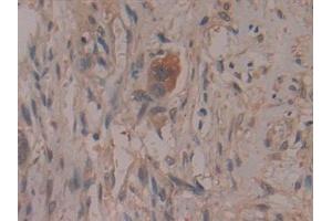 Detection of COX 2 in Human Pancreatic cancer Tissue using Polyclonal Antibody to Cyclooxygenase-2 (COX 2)