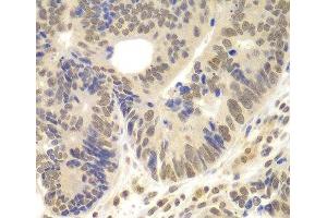 Immunohistochemistry of paraffin-embedded Human colon carcinoma using LHX4 Polyclonal Antibody at dilution of 1:100 (40x lens). (LHX4 anticorps)