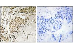 Immunohistochemistry analysis of paraffin-embedded human breast carcinoma tissue, using NOM1 Antibody. (NOM1 anticorps  (AA 661-710))