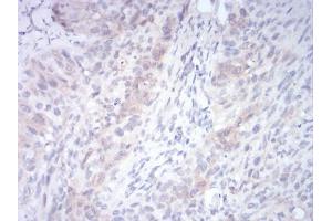 Immunohistochemical analysis of paraffin-embedded cervical cancer tissues using RND3 mouse mAb with DAB staining. (RND3 anticorps  (AA 104-241))