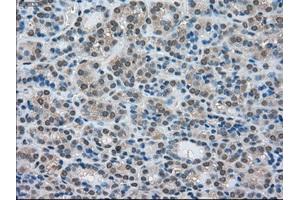 Immunohistochemical staining of paraffin-embedded Adenocarcinoma of breast tissue using anti-LDHA mouse monoclonal antibody. (Lactate Dehydrogenase A anticorps)
