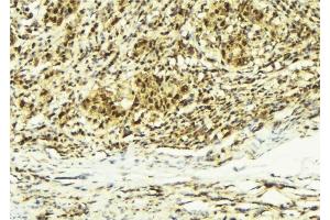 ABIN6279208 at 1/100 staining Human breast cancer tissue by IHC-P.
