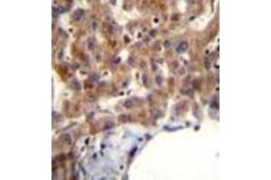 Immunohistochemistry analysis in formalin fixed and paraffin embedded human liver tissue reacted with MBNL2 Antibody (C-term) followed which was peroxidase conjugated to the secondary antibody and followed by AB staining. (MBNL2 anticorps  (C-Term))
