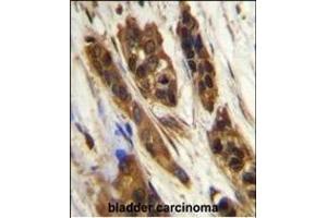 SNR27 Antibody (Center) (ABIN655835 and ABIN2845250) immunohistochemistry analysis in formalin fixed and paraffin embedded human bladder carcinoma followed by peroxidase conjugation of the secondary antibody and DAB staining.
