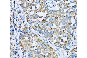 Immunohistochemistry of paraffin-embedded Human lung cancer using OGDH Polyclonal Antibody at dilution of 1:100 (40x lens).