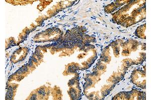 ABIN6263112 and ABIN6266890 at 1/100 staining Human prostate cancer by IHC-P. (MLK4 anticorps)