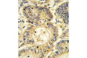 Formalin-fixed and paraffin-embedded human colon carcinoma reacted with SOCS1 Antibody (N-term), which was peroxidase-conjugated to the secondary antibody, followed by DAB staining.