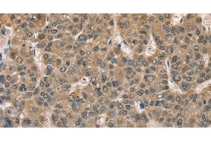 Immunohistochemistry of paraffin-embedded Human liver cancer tissue using DACH2 Polyclonal Antibody at dilution 1:40 (DACH2 anticorps)