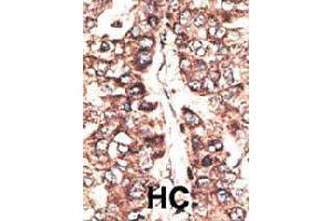 Formalin-fixed and paraffin-embedded human hepatocellular carcinoma tissue reacted with MAGEA11 polyclonal antibody  , which was peroxidase-conjugated to the secondary antibody, followed by DAB staining.