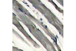 IHC analysis of FFPE human hepatocarcinoma stained with LRRK2 antibody