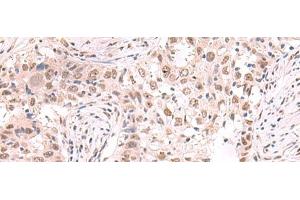 Immunohistochemistry of paraffin-embedded Human esophagus cancer tissue using ZNF559 Polyclonal Antibody at dilution of 1:80(x200) (ZNF559 anticorps)