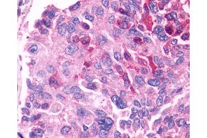 Anti-GPR27 antibody IHC of human prostate, carcinoma.