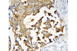 Anti-Presenilin 2 antibody, IHC(P) IHC(P): Human Mammary Cancer Tissue