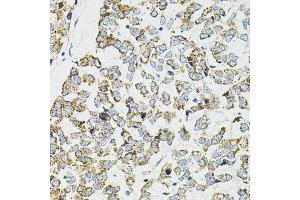 Immunohistochemistry of paraffin-embedded human esophageal cancer using PPP1CA antibody.