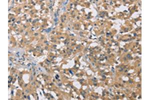 The image on the left is immunohistochemistry of paraffin-embedded Human thyroid cancer tissue using ABIN7129065(CST2 Antibody) at dilution 1/50, on the right is treated with fusion protein.