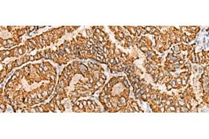 Immunohistochemistry of paraffin-embedded Human thyroid cancer tissue using NPC2 Polyclonal Antibody at dilution of 1:80(x200) (NPC2 anticorps)