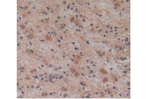 IHC-P analysis of Human Glioma Tissue, with DAB staining. (ALT anticorps  (AA 255-496))