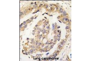 Formalin-fixed and paraffin-embedded human lung carcinoma tissue reacted with Olfm1 Antibody (N-term) (ABIN389177 and ABIN2839340) , which was peroxidase-conjugated to the secondary antibody, followed by DAB staining. (Olfactomedin 1 anticorps  (N-Term))