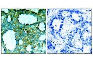 Immunohistochemical analysis of paraffin-embedded human breast carcinoma tissue using PAK1(Phospho-Thr212) Antibody(left) or the same antibody preincubated with blocking peptide(right). (PAK1 anticorps  (pThr212))