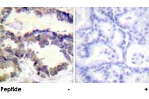 Immunohistochemical analysis of paraffin-embedded human lung carcinoma tissue using CASP2 polyclonal antibody . (Caspase 2 anticorps  (Ser140))