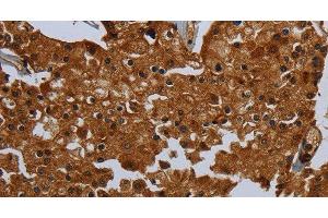 Immunohistochemistry of paraffin-embedded Human prostate cancer tissue using ENTPD7 Polyclonal Antibody at dilution 1:60 (ENTPD7 anticorps)