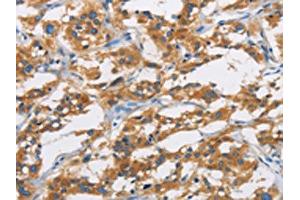 The image is immunohistochemistry of paraffin-embedded Human thyroid cancer tissue using ABIN7130969(SAR1B Antibody) at dilution 1/20. (SAR1B anticorps)