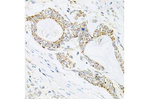 Immunohistochemistry of paraffin-embedded human gastric cancer using IRS1 antibody (ABIN5970075) at dilution of 1/100 (40x lens). (IRS1 anticorps)