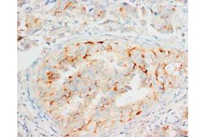 Immunohistochemical staining of OPCML on formalin fixed, paraffin embedded human mammary cancer with OPCML polyclonal antibody . (OPCML anticorps  (C-Term))