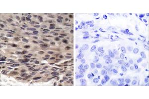 P-Peptide - +Immunohistochemical analysis of paraffin-embedded human breast carcinoma tissue using FKHRL1 (phospho-Ser253) antibody. (eIF4EBP1 anticorps  (pThr36))