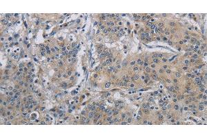 Immunohistochemistry of paraffin-embedded Human gastric cancer using DNAJB4 Polyclonal Antibody at dilution of 1:50 (DNAJB4 anticorps)