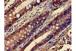 Immunohistochemistry of paraffin-embedded human colon cancer using ABIN7172843 at dilution of 1:100 (RHOA anticorps  (AA 1-191))
