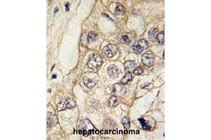 Formalin-fixed and paraffin-embedded human hepatocellular carcinoma tissue reacted with CDH6 polyclonal antibody , which was peroxidase-conjugated to the secondary antibody, followed by DAB staining. (CDH6 anticorps  (C-Term))