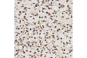 Immunohistochemistry of paraffin-embedded human kidney cancer tissue using H3R17me2a antibody at dilution of 1:200 (x400 lens) (Histone 3 anticorps  (H3R17me2a))