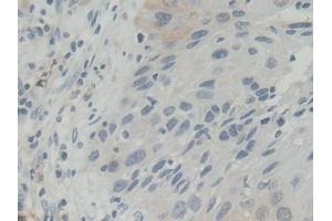 Detection of BLVRB in Human Lung cancer Tissue using Polyclonal Antibody to Biliverdin Reductase B (BLVRB) (BLVRB anticorps  (AA 2-206))