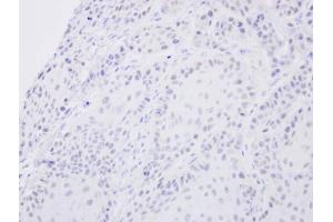 IHC-P Image Immunohistochemical analysis of paraffin-embedded Cal27 xenograft, using SENP2, antibody at 1:500 dilution. (SENP2 anticorps  (N-Term))