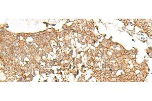 Immunohistochemistry of paraffin-embedded Human lung cancer tissue using PRLHR Polyclonal Antibody at dilution of 1:70(x200) (PRLHR anticorps)