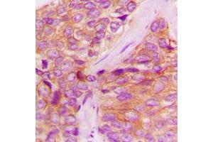 Immunohistochemical analysis of JAK1 (pY1022) staining in human breast cancer formalin fixed paraffin embedded tissue section. (JAK1 anticorps  (C-Term, pTyr1022))
