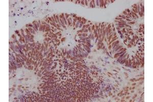 IHC image of ABIN7127630 diluted at 1:100 and staining in paraffin-embedded human ovarian cancer performed on a Leica BondTM system.