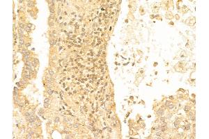 ABIN6259708 and ABIN6267079 at 1/100 staining Human lung cancer by IHC-P. (FOXO1 anticorps  (acLys294))
