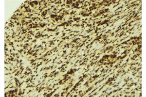ABIN6269360 at 1/100 staining Human breast cancer tissue by IHC-P. (STAT4 anticorps  (C-Term))
