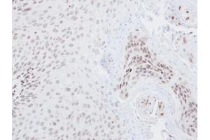 IHC-P Image Immunohistochemical analysis of paraffin-embedded Cal27 xenograft, using NRF2, antibody at 1:500 dilution.