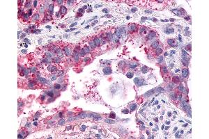 Anti-GPR1 antibody IHC of human Lung, Adenocarcinoma.