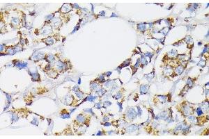 Immunohistochemistry of paraffin-embedded Human breast cancer using USP33 Polyclonal Antibody at dilution of 1:100 (40x lens).