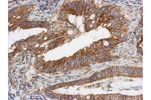 IHC-P Image Immunohistochemical analysis of paraffin-embedded human gastric cancer, using TSFM, antibody at 1:500 dilution. (TSFM anticorps)