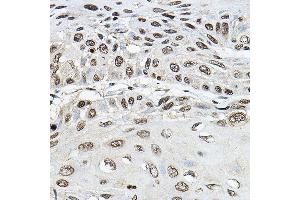 Immunohistochemistry of paraffin-embedded human esophageal cancer using TRRAP Rabbit pAb (ABIN7270906) at dilution of 1:100 (40x lens). (TRRAP anticorps)