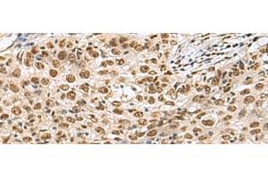 Immunohistochemistry of paraffin-embedded Human esophagus cancer tissue using PRPF40A Polyclonal Antibody at dilution of 1:60(x200) (PRPF40A anticorps)