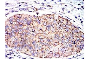 Immunohistochemical analysis of paraffin-embedded kidney cancer tissues using SERPINE1 mouse mAb with DAB staining.
