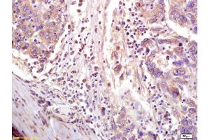 Formalin-fixed and paraffin embedded human lung carcinoma labeled with Anti-CTCF Polyclonal Antibody, Unconjugated (ABIN703976) at 1:200 followed by conjugation to the secondary antibody and DAB staining. (CTCF anticorps  (AA 451-550))